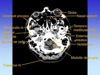 External auditory meatus 
Mastoid air cells 
Medulla oblangata 
Nasal septum 
Temporalis m 
Trapezius m 
Coronoid process 
Head of mandible 
Temporo- madibular joint 
Globe 
Vertebral a  