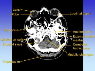 Auditory tube 
External auditory meatus 
Lacrimal gland 
Mastoid air cells 
Medulla oblongata 
Temporalis m 
Cerebellar hemisphere 
Trapezius m 
Sigmoid sinus 
Lens 
Globe  