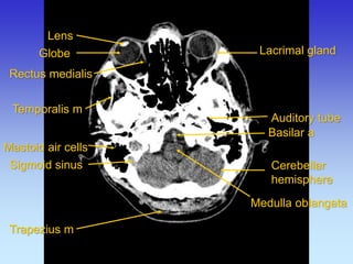 Auditory tube 
Lacrimal gland 
Mastoid air cells 
Medulla oblangata 
Rectus medialis 
Temporalis m 
Cerebellar hemisphere 
Trapezius m 
Sigmoid sinus 
Lens 
Globe 
Basilar a  