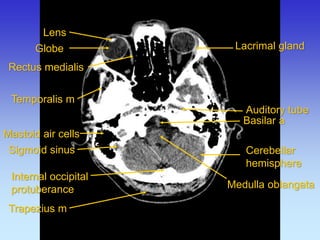 Auditory tube 
Internal occipital protuberance 
Lacrimal gland 
Mastoid air cells 
Medulla oblangata 
Rectus medialis 
Temporalis m 
Cerebellar hemisphere 
Trapezius m 
Sigmoid sinus 
Lens 
Globe 
Basilar a  