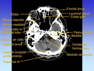 Internal occipital protuberance 
Frontal sinus 
Lacrimal gland 
Mastoid air cells 
Medulla oblangata 
Petrous bone 
Rectus lateralis 
Crista galli 
Temporalis m 
Temporal lobe 
Cerebellar hemisphere 
Trapezius m 
Sigmoid sinus 
Rectus medialis 
Globe 
Basillar a  