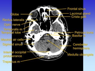Internal occipital protuberance 
Frontal sinus 
Lacrimal gland 
Mastoid air cells 
Medulla oblangata 
Petrous bone 
Rectus lateralis 
Optic nerve 
Crista galli 
Temporalis m 
Temporal lobe 
Cerebellar hemisphere 
Trapezius m 
Sigmoid sinus 
Globe 
Basillar a  