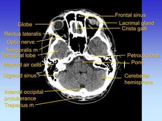 Internal occipital protuberance 
Frontal sinus 
Lacrimal gland 
Pons 
Mastoid air cells 
Petrous bone 
Rectus lateralis 
Optic nerve 
Crista galli 
Temporalis m 
Temporal lobe 
Cerebellar hemisphere 
Trapezius m 
Sigmoid sinus 
Globe  
