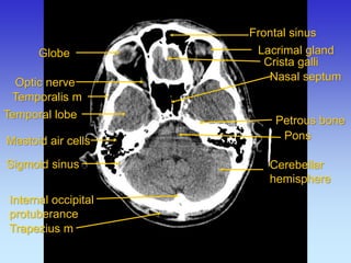 Internal occipital protuberance 
Frontal sinus 
Lacrimal gland 
Pons 
Mastoid air cells 
Nasal septum 
Petrous bone 
Optic nerve 
Crista galli 
Temporalis m 
Temporal lobe 
Cerebellar hemisphere 
Trapezius m 
Sigmoid sinus 
Globe  