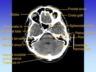 Crista galli 
Internal occipital protuberance 
Frontal sinus 
Pons 
Mastoid air cells 
Petrous bone 
Sphenoidal sinus 
Temporalis m 
Temporal lobe 
Cerebellar hemisphere 
Trapezius m 
Sigmoid sinus 
Globe  