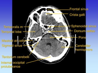 Crista galli 
Frontal sinus 
Pons 
Mastoid air cells 
Sphenoidal sinus 
Temporalis m 
Temporal lobe 
Cerebellar hemisphere 
Sigmoid sinus 
Dorsum sellae 
Internal occipital protuberance 
Tentorium cerebelli  