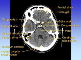 Crista galli 
Frontal sinus 
Pons 
Mastoid air cells 
Sella tursica 
Temporalis m 
Temporal lobe 
Cerebellar hemisphere 
Sigmoid sinus 
Dorsum sellae 
Internal occipital protuberance 
Tentorium cerebelli  