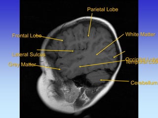 White Matter 
Occipital Lobe 
Cerebellum 
Grey Matter 
Frontal Lobe Lateral Sulcus 
Parietal Lobe 
Temporal Lobe  