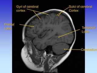 Gyri of cerebral cortex 
Sulci of cerebral Cortex 
Cerebellum 
Frontal Lobe 
Temporal 
Lobe  