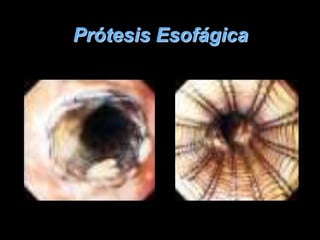 Prótesis Esofágica 
 