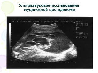 УУллььттррааззввууккооввооее ииссссллееддооввааннииее 
ммууццииннооззнноойй ццииссттааддееннооммыы 
 