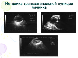 ММееттооддииккаа ттррааннссввааггииннааллььнноойй ппууннккццииии 
яяииччннииккаа 
 