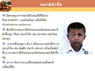 LOGO
พยาธิตัวจี๊ด
 มีสาเหตุมาจากพยาธิตัวกลมที่มีชื่อทาง
วิทยาศาสตร์ว่า แนธโธสโตมา สไปนิจิรัม
(Gnathostoma spinigerum)
 สัตว์ที่ตรวจพบว่ามีตัวอ่อนระยะติดต่อของพยาธิ
ตัวจี๊ดอยู่ ได้แก่ ปลาน้าจืด เช่น ปลาช่อน ปลาไหล
ปลาดุก
 อาหารที่ปรุงสุกๆ ดิบๆ หรืออาหารหมักที่ทาจาก
ปลาน้าจืด เช่น ส้มฟัก ปลาร้า ปลาเจ่า หรือเนื้อสัตว์
อื่นๆ อาจพบว่ามีตัวอ่อนระยะติดต่อของพยาธิตัวจี๊ด
อยู่
 อาการ มีอาการบวมที่ผิวหนังบริเวณที่พยาธิ
เคลื่อนที่ไป
 