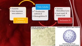 • Ausente
• Solo funciona
una cadena 
Síntesis
Cadena 
•  Producción
cadenas 
• Hemoglobina H
Vida Adulta
• Anemia
Hemolítica Leve
• Azul cresil 
Pelota Golf
Inclusión H
 