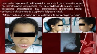 La excesiva regeneración eritropoyética puede dar lugar a masas tumorales
por hematopoyesis extramedular, con deformidades de huesos largos y
alteraciones craneofaciales muy características (prominencia frontal,
eminencia malar prominente o depresión del puente nasal).
Retraso de la maduración sexual debidas a la sobrecarga de hierro
 