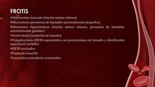 FROTIS
•Hipocromía marcada (tinción menos intensa)
•Microcitosis (presencia de hematíes anormalmente pequeños)
•Macrocitos hipocrómicos (tinción menos intensa, presencia de hematíes
anormalmente grandes)
•Anisocitosis (variación de tamaño)
•Poiquilocitosis (HEM especulados con proyecciones de tamaño y distribución
superficial variable)
•HEM nucleados
•Punteado basófilo
•Leucocitos inmaduros ocasionales
 
