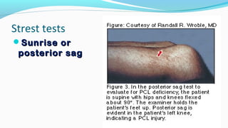 Strest tests
Sunrise orSunrise or
posterior sagposterior sag
 