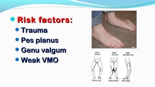 Risk factors:Risk factors:
TraumaTrauma
Pes planusPes planus
Genu valgumGenu valgum
Weak VMOWeak VMO
 