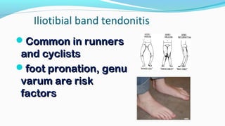 Iliotibial band tendonitis
Common in runnersCommon in runners
and cyclistsand cyclists
foot pronation, genufoot pronation, genu
varum are riskvarum are risk
factorsfactors
 