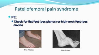Patellofemoral pain syndrome
PE:PE:
Check for flat feet (pes planus) or high-arch feet (pesCheck for flat feet (pes planus) or high-arch feet (pes
cavus)cavus)
Pes Planus Pes Cavus
 