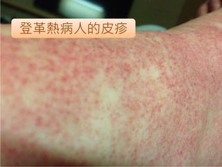 登革熱病人的皮疹
 