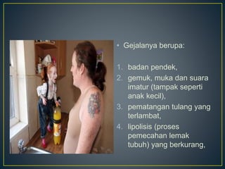 • Gejalanya berupa:
1. badan pendek,
2. gemuk, muka dan suara
imatur (tampak seperti
anak kecil),
3. pematangan tulang yang
terlambat,
4. lipolisis (proses
pemecahan lemak
tubuh) yang berkurang,
 