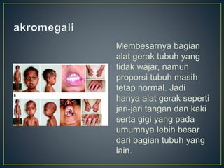 Membesarnya bagian
alat gerak tubuh yang
tidak wajar, namun
proporsi tubuh masih
tetap normal. Jadi
hanya alat gerak seperti
jari-jari tangan dan kaki
serta gigi yang pada
umumnya lebih besar
dari bagian tubuh yang
lain.
 