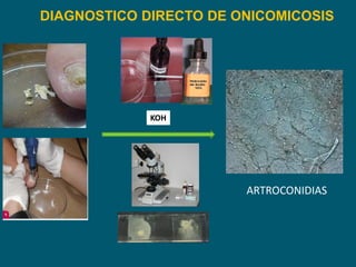 DIAGNOSTICO DIRECTO DE ONICOMICOSIS
ARTROCONIDIAS
KOH
 