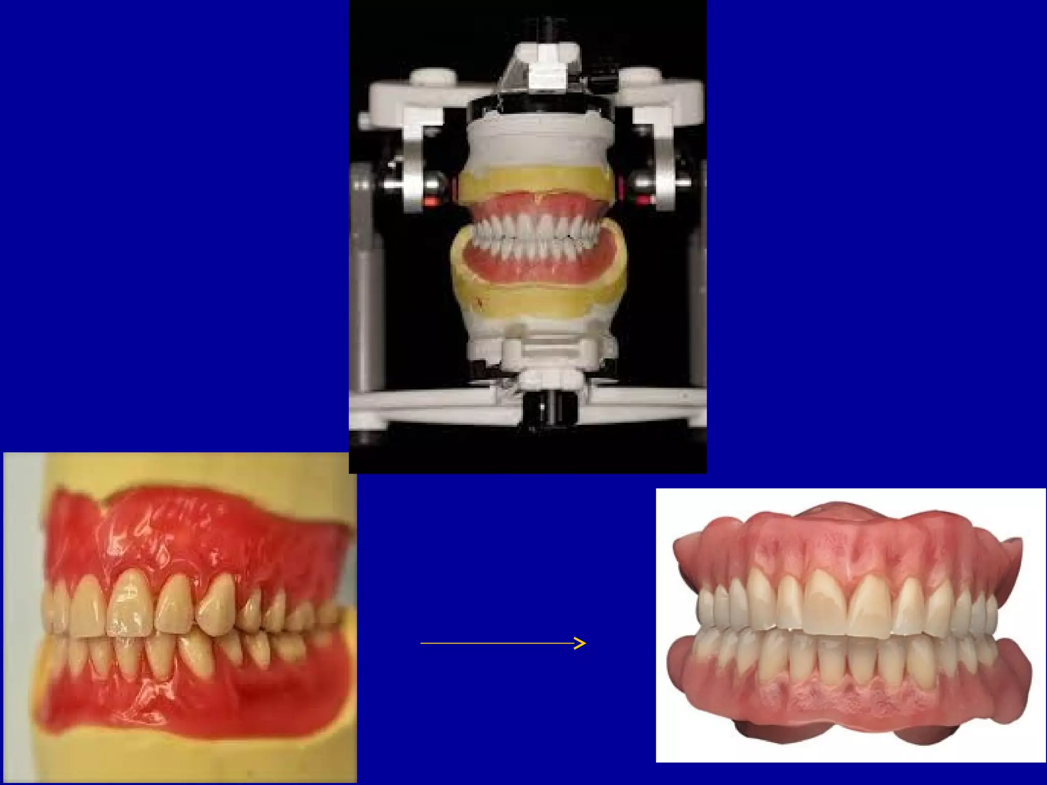 record bases & occlusal rims | PPT