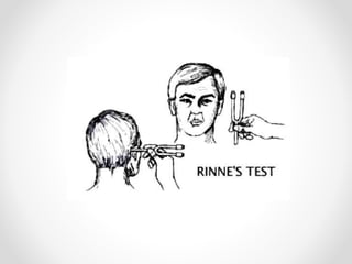 Modified Rinne
• For routine purpose ,the patient is asked to
compare the sound intensities of tuning fork, while
placing ...