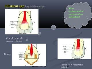 Pin Ledge 5.biologic considerations in fixed restorations 2013 | PPT