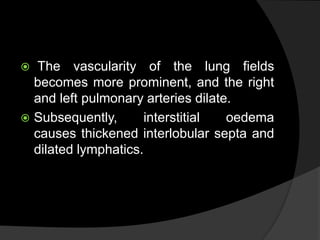  The vascularity of the lung fields
becomes more prominent, and the right
and left pulmonary arteries dilate.
 Subsequently, interstitial oedema
causes thickened interlobular septa and
dilated lymphatics.
 