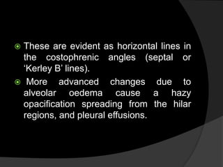  These are evident as horizontal lines in
the costophrenic angles (septal or
‘Kerley B’ lines).
 More advanced changes due to
alveolar oedema cause a hazy
opacification spreading from the hilar
regions, and pleural effusions.
 