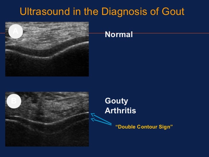 Gout in Adults: Condition, Treatments, and Pictures ...