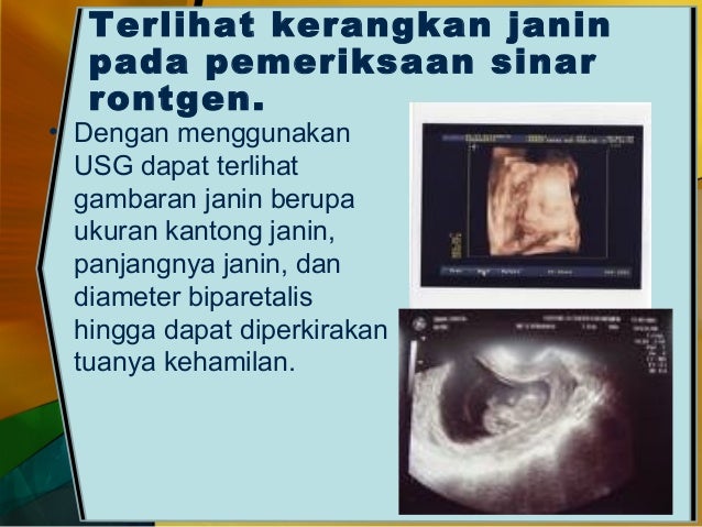5. tanda tanda kehamilan--