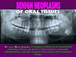 Ne o : ne w; Plasia: fo rm atio n. A neoplasm is defined as an uncoordinated
proliferation of tissue, the growth of which persists in a potentially
unlimited fashion, even after cessation of the stimulus which evoked the
change.
 