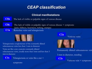 pulmonary embolism | PPT