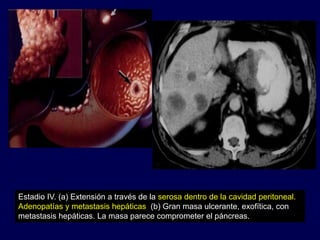 Estadio IV. (a) Extensión a través de la serosa dentro de la cavidad peritoneal.
Adenopatías y metastasis hepáticas (b) Gran masa ulcerante, exofítica, con
metastasis hepáticas. La masa parece comprometer el páncreas.
 