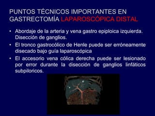 PUNTOS TÉCNICOS IMPORTANTES EN
GASTRECTOMÍA LAPAROSCÓPICA DISTAL
• Abordaje de la arteria y vena gastro epiploica izquierda.
Disección de ganglios.
• El tronco gastrocólico de Henle puede ser erróneamente
disecado bajo guía laparoscópica
• El accesorio vena cólica derecha puede ser lesionado
por error durante la disección de ganglios linfáticos
subpiloricos.
 