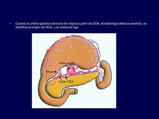 • Cuando la arteria gástrica derecha de origina a partir de GDA, el estómago debe se evertido, se
identifica el origen de RGA, y la arteria se liga.
 