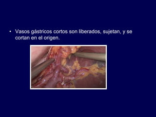 • Vasos gástricos cortos son liberados, sujetan, y se
cortan en el origen.
 