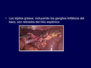 • Los tejidos grasos, incluyendo los ganglios linfáticos del
bazo, son retirados del hilio esplénico
 