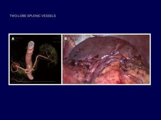 TWO-LOBE SPLENIC VESSELS
 