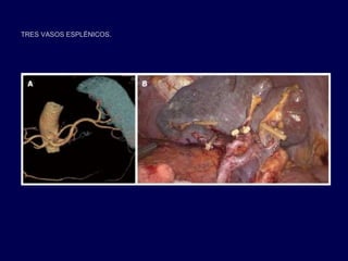 TRES VASOS ESPLÉNICOS.
 