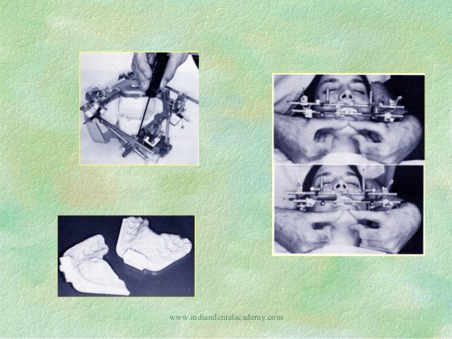 Straight Line Articulator : Articulators dental courses