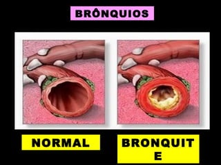 NORMAL BRONQUIT
E
BRÔNQUIOS
 