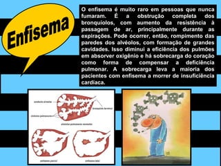 O enfisema é muito raro em pessoas que nunca
fumaram. É a obstrução completa dos
bronquíolos, com aumento da resistência à
passagem de ar, principalmente durante as
expirações. Pode ocorrer, então, rompimento das
paredes dos alvéolos, com formação de grandes
cavidades. Isso diminui a eficiência dos pulmões
em absorver oxigênio e há sobrecarga do coração
como forma de compensar a deficiência
pulmonar. A sobrecarga leva a maioria dos
pacientes com enfisema a morrer de insuficiência
cardíaca.
 