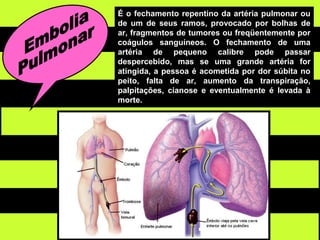 É o fechamento repentino da artéria pulmonar ou
de um de seus ramos, provocado por bolhas de
ar, fragmentos de tumores ou freqüentemente por
coágulos sanguíneos. O fechamento de uma
artéria de pequeno calibre pode passar
despercebido, mas se uma grande artéria for
atingida, a pessoa é acometida por dor súbita no
peito, falta de ar, aumento da transpiração,
palpitações, cianose e eventualmente é levada à
morte.
 