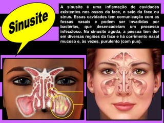 A sinusite é uma inflamação de cavidades
existentes nos ossos da face, o seio da face ou
sinus. Essas cavidades tem comunicação com as
fossas nasais e podem ser invadidas por
bactérias, que desencadeiam um processo
infeccioso. Na sinusite aguda, a pessoa tem dor
em diversas regiões da face e há corrimento nasal
mucoso e, às vezes, purulento (com pus).
 