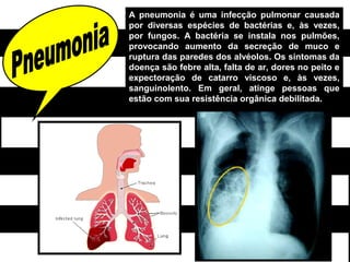 A pneumonia é uma infecção pulmonar causada
por diversas espécies de bactérias e, às vezes,
por fungos. A bactéria se instala nos pulmões,
provocando aumento da secreção de muco e
ruptura das paredes dos alvéolos. Os sintomas da
doença são febre alta, falta de ar, dores no peito e
expectoração de catarro viscoso e, às vezes,
sanguinolento. Em geral, atinge pessoas que
estão com sua resistência orgânica debilitada.
 